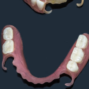Removable Dentures Flexible, Devoid Of Nylon, Hypoallergenic Exe